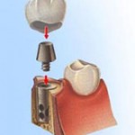 implants dental implant